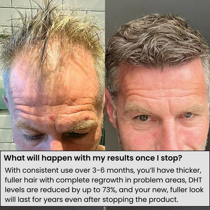 ALPHA™ Hair Regrowth System