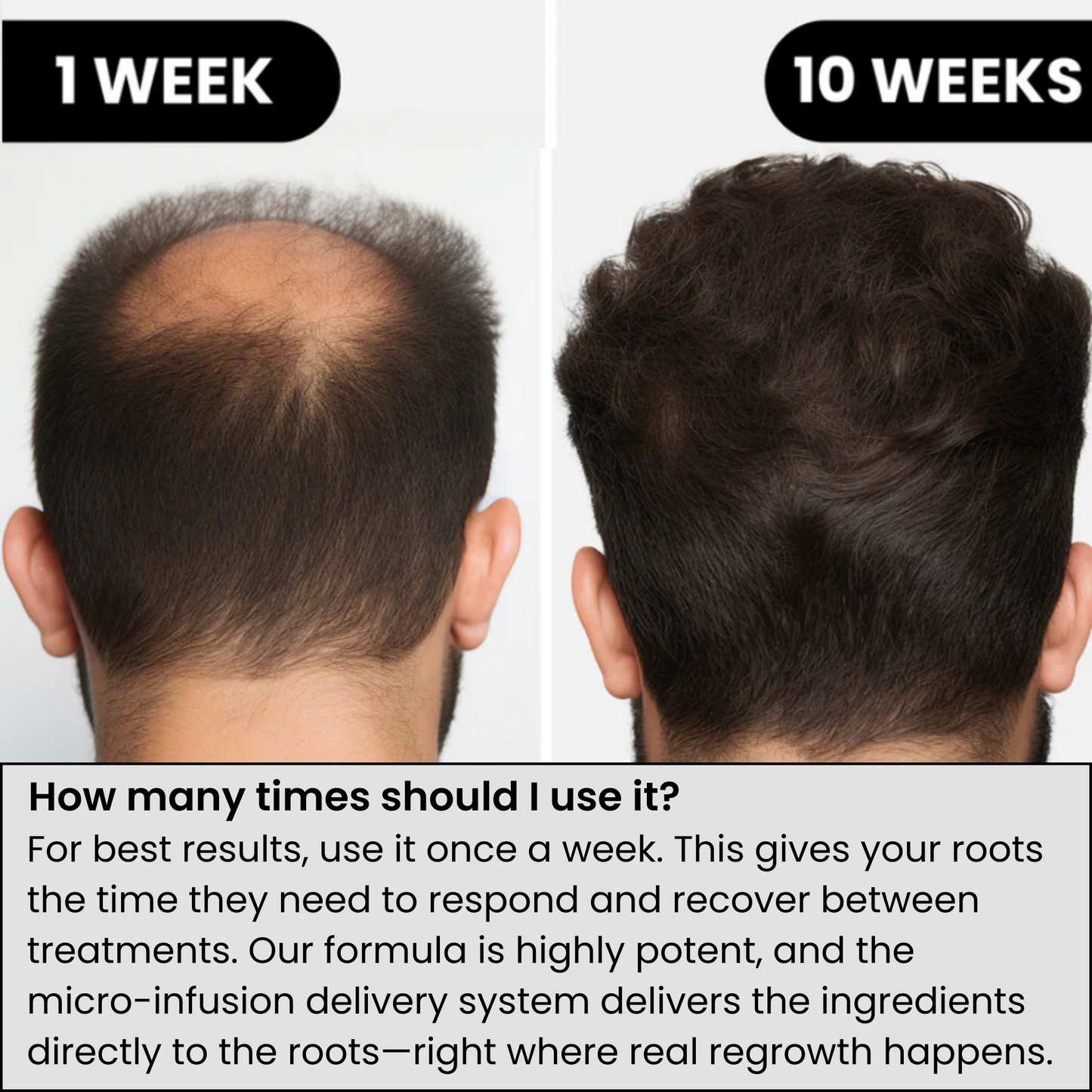 ALPHA™ Hair Regrowth System