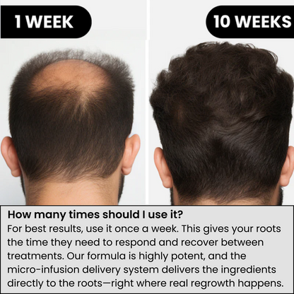 ALPHA™ Hair Regrowth System